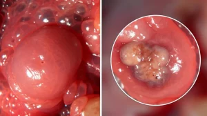 Primo piano di una cistifellea umana sana e una affetta da cancro, visualizzate fianco a fianco in un contesto medico-scientifico, illuminazione da laboratorio, lente macro 90mm, alto dettaglio, messa a fuoco selettiva sulla parte malata.