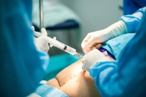 Primo piano di una siringa che preleva liquido cerebrospinale durante una puntura lombare, ambiente ospedaliero sterile, illuminazione clinica focalizzata, alta definizione, dettagli nitidi sulla procedura medica, lente macro 85mm.