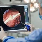 Primo piano di un radiologo interventista che osserva attentamente uno schermo di navigazione 3D durante una procedura di ablazione per osteoma osteoide. Focus sullo schermo che mostra l'anatomia ossea e la traiettoria dell'ago, e sulle mani guantate del medico che controllano gli strumenti. Lente prime 50mm, profondità di campo ridotta che sfoca lo sfondo della sala operatoria, illuminazione focalizzata sullo schermo e sul medico.