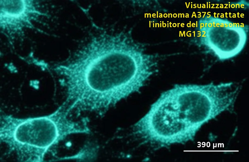 Visualizzazione microscopica ad alta risoluzione di cellule di melanoma A375 trattate con l'inibitore del proteasoma MG132, mostrando chiari segni di apoptosi come il restringimento cellulare e la frammentazione. Obiettivo prime 35mm, profondità di campo accentuata per isolare le cellule, illuminazione da laboratorio controllata.
