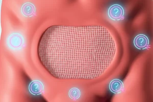 Immagine concettuale che mostra una rete chirurgica (mesh) traslucida sovrapposta a un'illustrazione anatomica stilizzata della parete addominale. Intorno fluttuano punti interrogativi luminosi e icone stilizzate che rappresentano dolore e disagio, simboleggiando l'incertezza sui risultati a lungo termine (dolore cronico, sensazione di corpo estraneo) della riparazione dell'ernia ventrale in base al posizionamento della rete. Macro lens, 80mm, high detail, illuminazione controllata e drammatica.