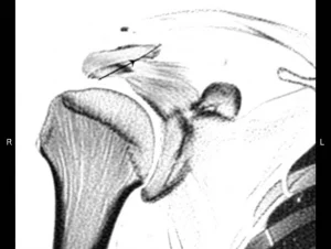 Primo piano di una sezione sagittale di risonanza magnetica della spalla, evidenziando la 'vista a r' all'incisura sovrascapolare, alta definizione, illuminazione controllata, obiettivo macro 90mm, che mostra chiaramente il muscolo sovraspinato con infiltrazione grassa moderata.