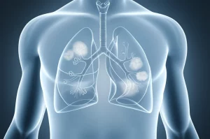 Immagine concettuale di polmoni umani trasparenti che mostrano gli alveoli, con alcune aree leggermente opache a simboleggiare una ridotta funzione, sovrapposti a una fiala di desametasone. Sfondo astratto blu e grigio. Obiettivo prime 35mm, profondità di campo, stile duotone blu e grigio.