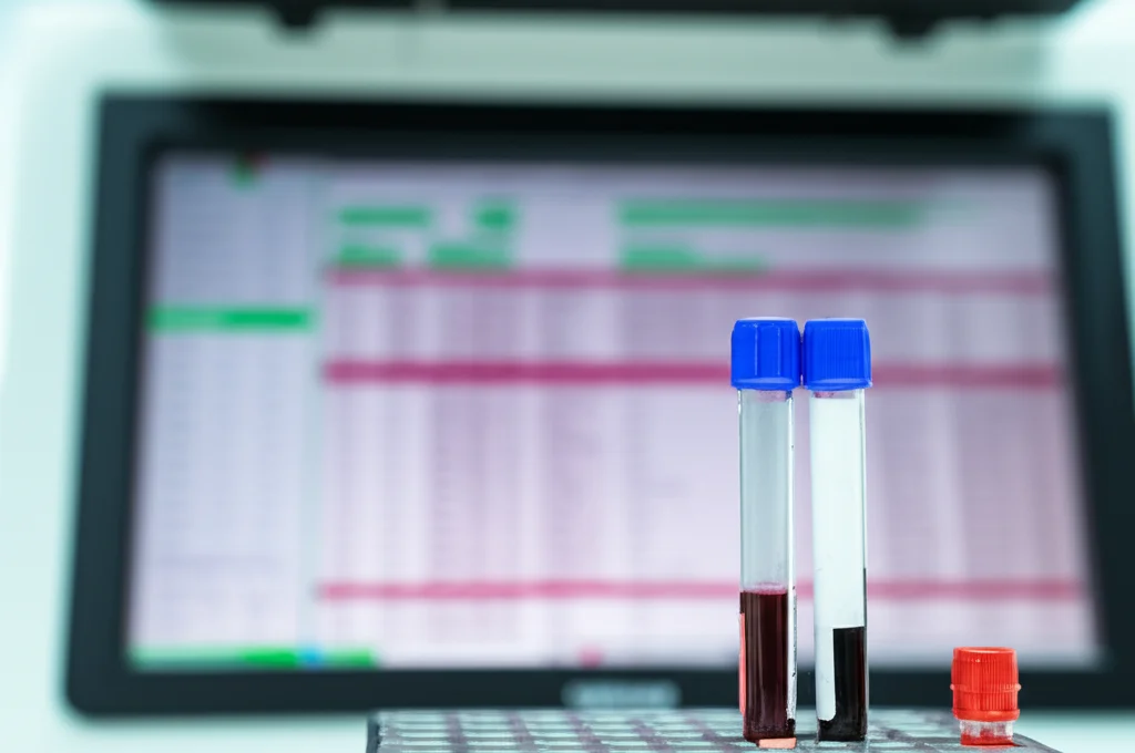 Primo piano di una provetta di sangue analizzata in un moderno laboratorio, con focus sui risultati del conteggio degli eosinofili visibili su uno schermo vicino, obiettivo macro 85mm, illuminazione controllata, alta definizione.