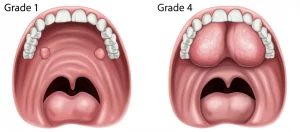 Illustrazione medica comparativa che mostra a sinistra una gola con tonsille palatine di grado 1 (piccole) e un'arcata dentale superiore ampia e ben formata, e a destra una gola con tonsille di grado 4 (molto grandi, quasi a contatto) e un'arcata dentale superiore visibilmente stretta e con palato profondo. Stile fotorealistico medico, illuminazione chiara e dettagliata.
