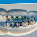 Immagine macro ad alta definizione di un apparecchio ortodontico linguale completamente personalizzato applicato sulla superficie interna dei denti di un modello dentale. Illuminazione da studio precisa che evidenzia la complessità e la personalizzazione dei bracket. Obiettivo macro 100mm, messa a fuoco selettiva.