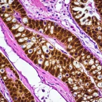 Immagine fotorealistica al microscopio di cellule tumorali del colon-retto con espressione di PD-L1 evidenziata da colorazione immunoistochimica marrone. Dettaglio elevato, illuminazione da microscopia, obiettivo macro 100mm, che simboleggia la ricerca sulle disparità sanitarie e l'immunoterapia nel cancro.
