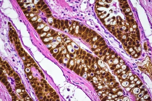 Immagine fotorealistica al microscopio di cellule tumorali del colon-retto con espressione di PD-L1 evidenziata da colorazione immunoistochimica marrone. Dettaglio elevato, illuminazione da microscopia, obiettivo macro 100mm, che simboleggia la ricerca sulle disparità sanitarie e l'immunoterapia nel cancro.