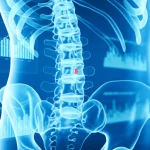Visualizzazione 3D della colonna vertebrale lombare con segni di scoliosi degenerativa, sovrapposta a grafici stilizzati che rappresentano i livelli di ALP e Creatinina nel sangue, concetto di screening diagnostico e biomarcatori, colori blu e bianco duotone, obiettivo 35mm, profondità di campo per mettere a fuoco sia la colonna che i grafici.