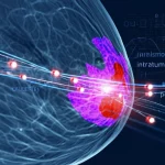 Immagine concettuale fotorealistica che mostra una scansione RM del seno con sovrapposizioni digitali luminose di dati radiomici, evidenziando chiaramente le aree intratumorali (rosse) e peritumorali (viola). Profondità di campo, obiettivo 35mm, toni blu e viola duotone per un look tecnologico e medico.