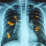 Primo piano di polmoni umani visualizzati tramite una radiografia medica illuminata, con evidenza di noduli diffusi e linfoadenopatia. Stile fotorealistico, obiettivo prime 35mm, profondità di campo, illuminazione drammatica che enfatizza le aree patologiche.