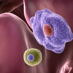 Immagine fotorealistica concettuale che mostra una sezione trasversale stilizzata di un linfonodo cervicale con due distinte popolazioni cellulari tumorali (una rappresentante il carcinoma papillare tiroideo metastatico, l'altra il linfoma non-Hodgkin indolente) coesistenti al suo interno. Illuminazione drammatica, obiettivo prime 50mm, profondità di campo ridotta per focalizzare sull'interazione cellulare.