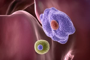 Immagine fotorealistica concettuale che mostra una sezione trasversale stilizzata di un linfonodo cervicale con due distinte popolazioni cellulari tumorali (una rappresentante il carcinoma papillare tiroideo metastatico, l'altra il linfoma non-Hodgkin indolente) coesistenti al suo interno. Illuminazione drammatica, obiettivo prime 50mm, profondità di campo ridotta per focalizzare sull'interazione cellulare.