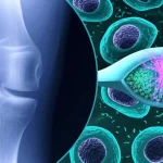 Immagine concettuale fotorealistica, obiettivo 35mm prime, che mostra una fusione: metà raffigura una precisa osteotomia tibiale alta chirurgica su una radiografia del ginocchio, l'altra metà mostra vibranti cellule staminali mesenchimali (hUCB-MSC) che rigenerano il tessuto cartilagineo, profondità di campo, duotono blu e bianco.