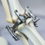 Primo piano di un fissatore esterno ortopedico innovativo montato sull'arto di un cavallo (modello anatomico o simulazione realistica), con focus sulle viti inserite nell'osso MC III sano sopra l'area della frattura (non visibile), illuminazione da studio controllata, obiettivo macro 100mm, alta definizione dei dettagli metallici e della texture ossea.