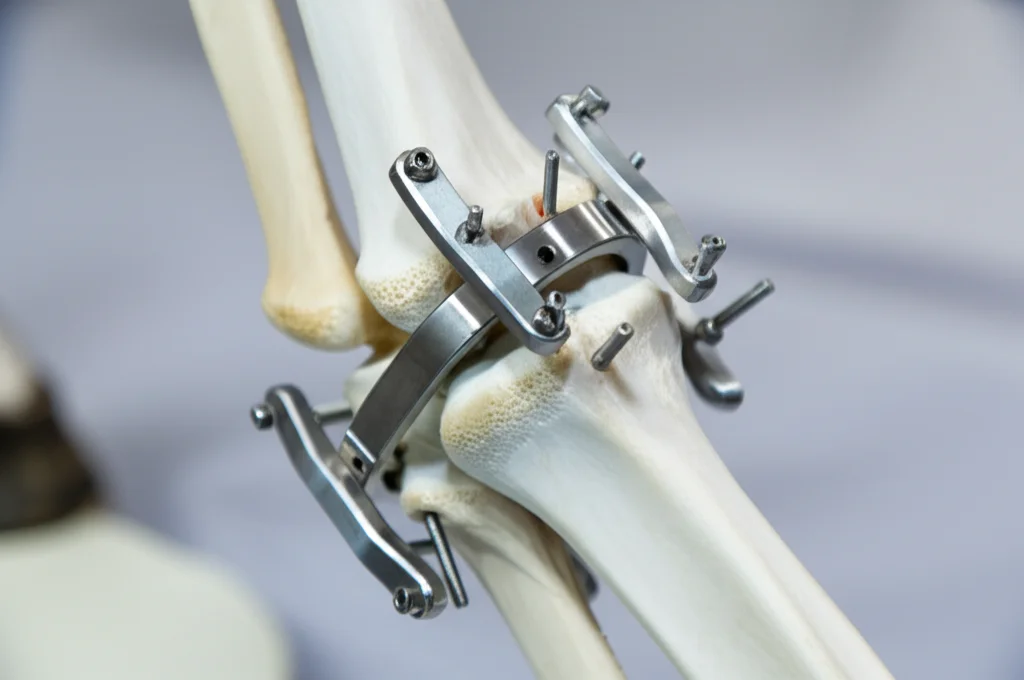 Primo piano di un fissatore esterno ortopedico innovativo montato sull'arto di un cavallo (modello anatomico o simulazione realistica), con focus sulle viti inserite nell'osso MC III sano sopra l'area della frattura (non visibile), illuminazione da studio controllata, obiettivo macro 100mm, alta definizione dei dettagli metallici e della texture ossea.