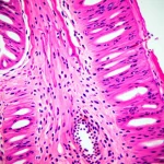Immagine macro di una sezione trasversale di tessuto intestinale ischemico, mostrando necrosi, infiammazione e piccole perforazioni. Macro lens, 100mm, high detail, precise focusing, controlled lighting.