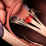Visualizzazione medica dettagliata di un cuore affetto da cardiomiopatia ipertrofica ostruttiva, con enfasi sull'ostruzione del tratto di efflusso ventricolare sinistro causata dall'ispessimento del setto e dal movimento anomalo della valvola mitrale (SAM), illuminazione drammatica che evidenzia le aree patologiche, obiettivo macro 70mm, alta definizione.