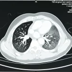 Immagine radiografica TC del torace in sezione assiale che mostra un grave pneumotorace iperteso a destra, con il polmone destro completamente collassato contro l'ilo e una marcata deviazione del mediastino e della trachea verso sinistra. Immagine medica diagnostica, alta definizione, visualizzata su schermo luminoso.