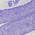 Microscopia elettronica a trasmissione (TEM) di un glomerulo renale, obiettivo macro 105mm, alta definizione, illuminazione precisa, che evidenzia la struttura dei podociti e la fusione dei processi podocitari (FPE) in un paziente con Nefropatia da IgA.