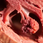 Immagine fotorealistica di un cuore umano in sezione trasversale che mostra un tumore benigno (mixoma cardiaco) con insolite caratteristiche ghiandolari all'interno dell'atrio sinistro. Lo stile è quello di un'illustrazione medica ad alta definizione, con messa a fuoco precisa e illuminazione controllata, obiettivo macro 70mm.