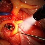 Visualizzazione medica avanzata che mostra un fegato trapiantato con dotti biliari evidenziati. Un fascio di luce stilizzato collega un endoscopio e uno strumento percutaneo vicino a un'anastomosi biliare, con piccoli magneti visibili nel punto di connessione. Illuminazione drammatica, alta definizione, obiettivo macro 70mm, focus preciso sulla zona dell'anastomosi, sfondo scuro e tecnico.