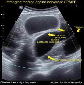 Immagine medica ecografica che mostra l'ago durante l'esecuzione di un blocco nervoso SPSIPB, con evidenziazione dei piani muscolari (trapezio, romboide, serrato posteriore superiore) e delle coste. Obiettivo lineare ad alta frequenza, messa a fuoco precisa sull'ago e sulla diffusione dell'anestetico locale nel piano fasciale corretto.