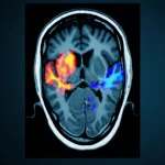 Immagine composita stilizzata che mostra due tipi di scansioni cerebrali PET, una per l'amiloide con colori caldi per le placche e una per il metabolismo FDG con colori freddi per l'ipometabolismo, sovrapposte a una silhouette di testa umana. Illuminazione drammatica, focus nitido sulle scansioni. Obiettivo prime 35mm, profondità di campo.