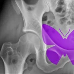 Immagine concettuale che mostra la sovrapposizione stilizzata di un simbolo del lupus (farfalla viola) su una radiografia in bianco e nero di un'articolazione dell'anca affetta da osteonecrosi. Tonalità duotone viola e grigio, profondità di campo, lente 35mm per un effetto drammatico ma informativo, stile film noir.