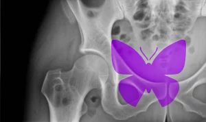 Immagine concettuale che mostra la sovrapposizione stilizzata di un simbolo del lupus (farfalla viola) su una radiografia in bianco e nero di un'articolazione dell'anca affetta da osteonecrosi. Tonalità duotone viola e grigio, profondità di campo, lente 35mm per un effetto drammatico ma informativo, stile film noir.