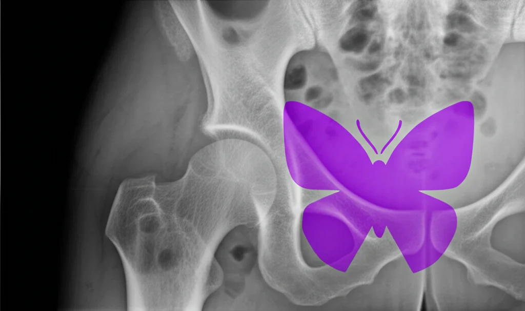 Immagine concettuale che mostra la sovrapposizione stilizzata di un simbolo del lupus (farfalla viola) su una radiografia in bianco e nero di un'articolazione dell'anca affetta da osteonecrosi. Tonalità duotone viola e grigio, profondità di campo, lente 35mm per un effetto drammatico ma informativo, stile film noir.