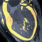 Immagine medica fotorealistica ad alta risoluzione di un cuore umano visualizzato tramite risonanza magnetica cardiaca (CMR). L'immagine mostra chiaramente il muscolo cardiaco (miocardio), il grasso epicardico (EAT) che lo avvolge come un sottile strato giallastro, e aree con texture alterata o segnale diverso indicative di fibrosi miocardica diffusa. Illuminazione clinica controllata, obiettivo macro virtuale 100mm per massimo dettaglio, focus preciso sulle strutture cardiache.