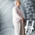 Immagine fotorealistica di una radiografia della colonna lombare che mostra viti peduncolari unilaterali (UPSF) dopo un intervento TLIF, sovrapposta a un'immagine sfocata di un paziente anziano che si muove comodamente, obiettivo 50mm, profondità di campo.