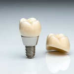 Immagine macro ad alta definizione di un impianto dentale in zirconia in due pezzi accanto a una corona protesica in ceramica avvitata, 100mm Macro lens, illuminazione da studio controllata, su sfondo pulito e professionale.