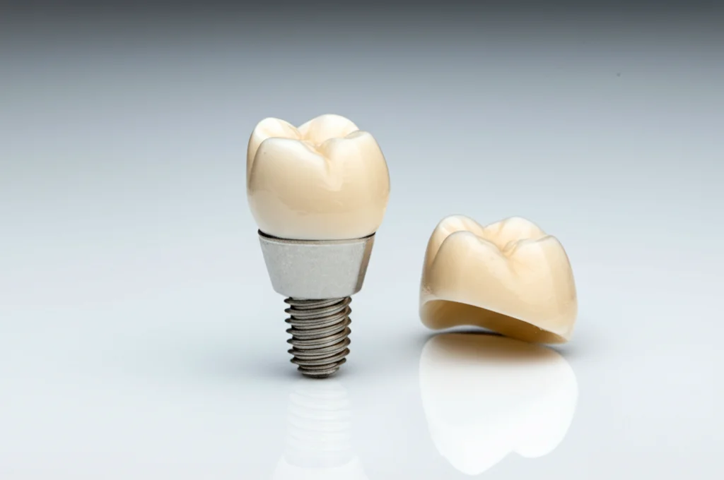 Immagine macro ad alta definizione di un impianto dentale in zirconia in due pezzi accanto a una corona protesica in ceramica avvitata, 100mm Macro lens, illuminazione da studio controllata, su sfondo pulito e professionale.