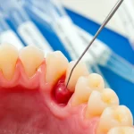 Macro shot, 85mm lens, con focus nitido su gengiva umana infiammata (rossa e leggermente gonfia) vicino a un dente, mentre una sonda parodontale misura la profondità della tasca gengivale. Sullo sfondo, leggermente sfocati ma riconoscibili, ci sono provette Eppendorf contenenti campioni di GCF su strisce di carta. L'illuminazione è controllata, tipica di un ambiente clinico/laboratorio, per massimizzare i dettagli.
