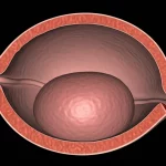 Visualizzazione 3D medica ad alta definizione di una vescica umana sezionata, obiettivo macro 60mm, che mostra un grande leiomioma liscio e ben circoscritto al suo interno, illuminazione clinica precisa, dettagli anatomici accurati.