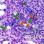 Immagine concettuale del microambiente tumorale del polmone con cellule immunitarie (T cells, B cells, macrofagi) che interagiscono con cellule tumorali e vasi sanguigni (cellule endoteliali), evidenziando i percorsi di segnalazione come VEGF e PD-1/PD-L1. Fotografia scientifica concettuale, obiettivo 50mm, profondità di campo media per mantenere a fuoco le interazioni chiave, colori realistici ma con enfasi grafica sui segnali molecolari VEGF e PLA2G4A.