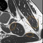 Immagine fotorealistica di una Risonanza Magnetica della coscia che evidenzia pattern di coinvolgimento muscolare distinti tra IMNM e Dermatomiosite, con aree illuminate a rappresentare edema o infiltrazione grassa nei compartimenti specifici. Stile diagnostico, alta definizione, prime lens 35mm, profondità di campo.
