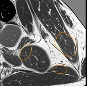 Immagine fotorealistica di una Risonanza Magnetica della coscia che evidenzia pattern di coinvolgimento muscolare distinti tra IMNM e Dermatomiosite, con aree illuminate a rappresentare edema o infiltrazione grassa nei compartimenti specifici. Stile diagnostico, alta definizione, prime lens 35mm, profondità di campo.