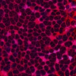 Microscopia ad alta risoluzione di tessuto epatico umano affetto da steatoepatite non alcolica (NASH), che mostra accumulo di grasso (steatosi), infiammazione lobulare e segni iniziali di fibrosi perisinusoidale. Illuminazione controllata, obiettivo macro 100mm, alta definizione dei dettagli cellulari.