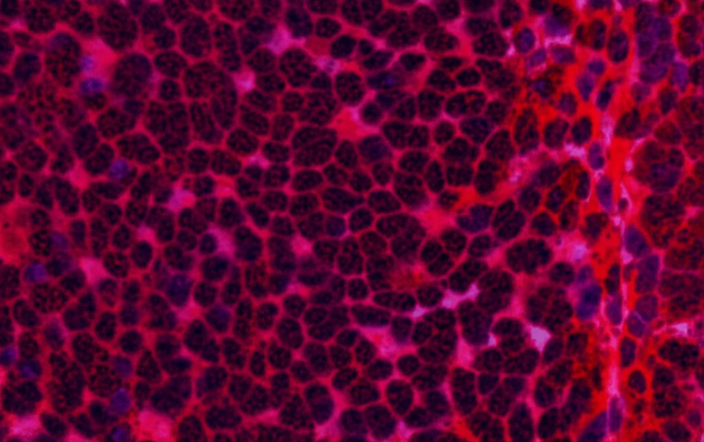 Microscopia ad alta risoluzione di tessuto epatico umano affetto da steatoepatite non alcolica (NASH), che mostra accumulo di grasso (steatosi), infiammazione lobulare e segni iniziali di fibrosi perisinusoidale. Illuminazione controllata, obiettivo macro 100mm, alta definizione dei dettagli cellulari.