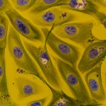 Immagine fotorealistica, obiettivo macro 100mm, alta definizione, illuminazione controllata, che mostra una vista ravvicinata all'interno di una piastra di Petri con cellule di cancro colon-rettale al microscopio, alcune cellule brillano sottilmente per indicare l'espressione proteica o la mutazione.