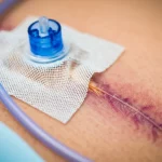 Close-up macro shot, 100mm lens, di una medicazione per terapia a pressione negativa (NPWT) applicata sulla zona toracica vicino a una cicatrice simulata da pacemaker, alta definizione, illuminazione medica controllata, focus sulla texture della medicazione e del tubo di drenaggio.