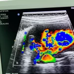 Descrizione dettagliata: Primo piano di un'ecografia avanzata (HFR CEUS con CVI) di un linfonodo superficiale su uno schermo medico, evidenziando i pattern di flusso sanguigno con colori e vettori, tecnologia medica all'avanguardia, obiettivo macro 100mm, alta definizione, illuminazione clinica controllata.