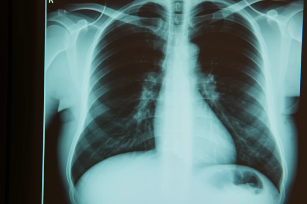 Radiografia toracica (Chest X-ray) che mostra una massa polmonare sospetta nel polmone sinistro, illuminata su uno schermo in una stanza di consultazione medica scarsamente illuminata, stile film noir, obiettivo 35mm, profondità di campo accentuata per dare un senso di mistero diagnostico.