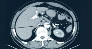 Visualizzazione grafica di un nomogramma medico per la previsione della durata del trattamento antibiotico, sovrapposto a un'immagine sfocata di una TAC epatica che mostra un ascesso, illuminazione da studio medico, obiettivo 50mm, alta definizione, colori blu e grigio duotone.