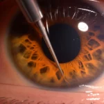 Immagine macro fotorealistica dell'angolo irido-corneale di un occhio durante un intervento chirurgico MIGS come la GATT. Si vede lo strumento chirurgico vicino al trabecolato. Obiettivo macro 100mm, alta definizione, illuminazione chirurgica controllata, focus preciso sulla zona di intervento.