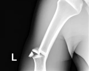 Radiografia del gomito di un bambino con una frattura di Monteggia cronica non trattata, che mostra la lussazione della testa radiale e segni iniziali di ossificazione eterotopica. Immagine medica dettagliata, obiettivo macro 70mm, illuminazione da studio per massima chiarezza diagnostica.
