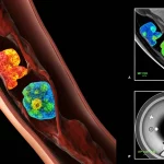 Immagine composita fotorealistica che mostra una sezione trasversale di un'arteria umana con placca aterosclerotica avanzata (depositi lipidici e calcificazioni evidenti) accanto a visualizzazioni stilizzate di scansioni PET/CT colorate che indicano aree di infiammazione (rosso/giallo con 18F-FDG) e calcificazione attiva (blu/verde con 18F-NaF), obiettivo macro 80mm, alta definizione, illuminazione da studio drammatica.